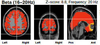 beta wave brain scan before neurofeedback therapy